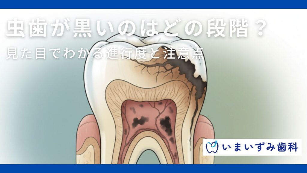 虫歯が黒いのはどの段階？見た目でわかる進行度と注意点
